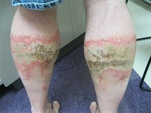 Workers must take steps to prevent concrete burns.